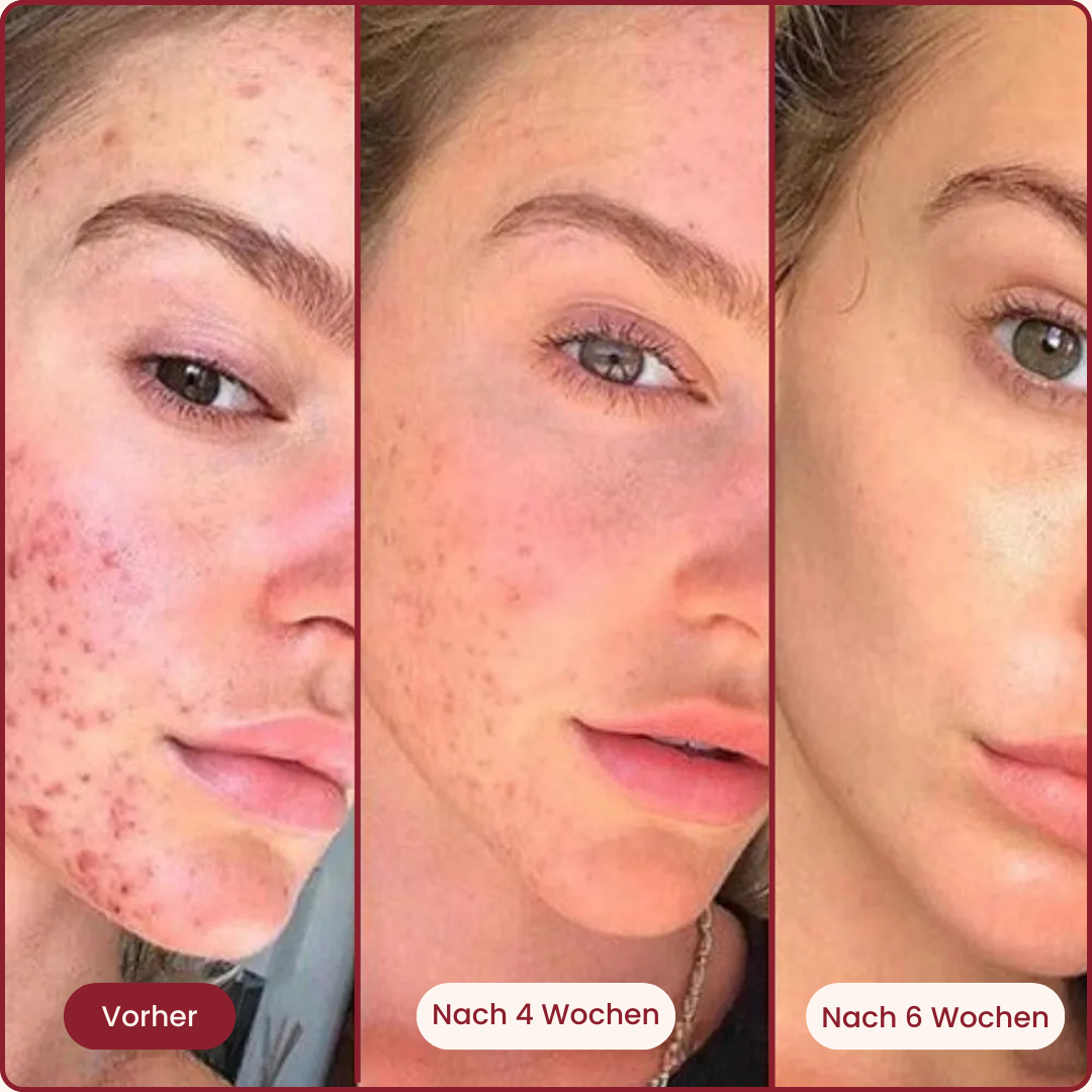 Spotless Serum™